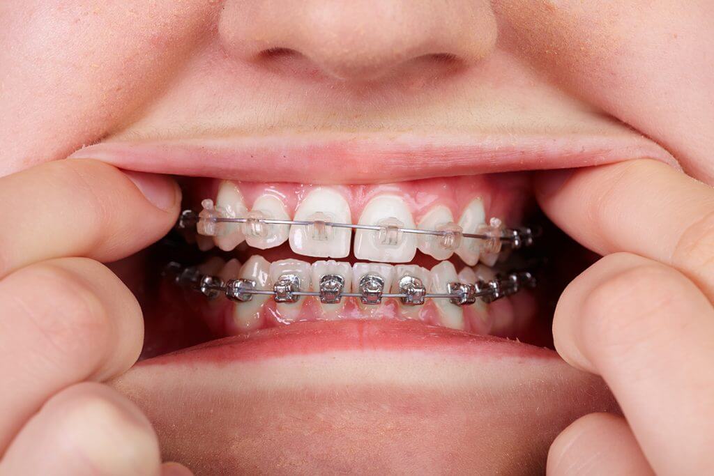 clear metal braces